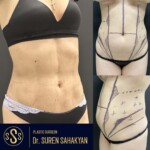 Tummy Tuck Abdominoplasty removes excess skin and fat from abdomen, plastic surgery