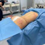 butt lipofilling in yerevan plastic surgery
