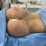 увеличение подтяжка ягодиц ереван краснодар др сурен саакян пластический хирург