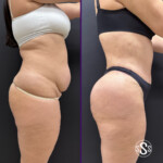 pori plastika bjishk suren sahakyan yerevan plastik virabuyj abdominoplastika