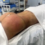 հետույքի մեծացում լիպոֆիլինգ
